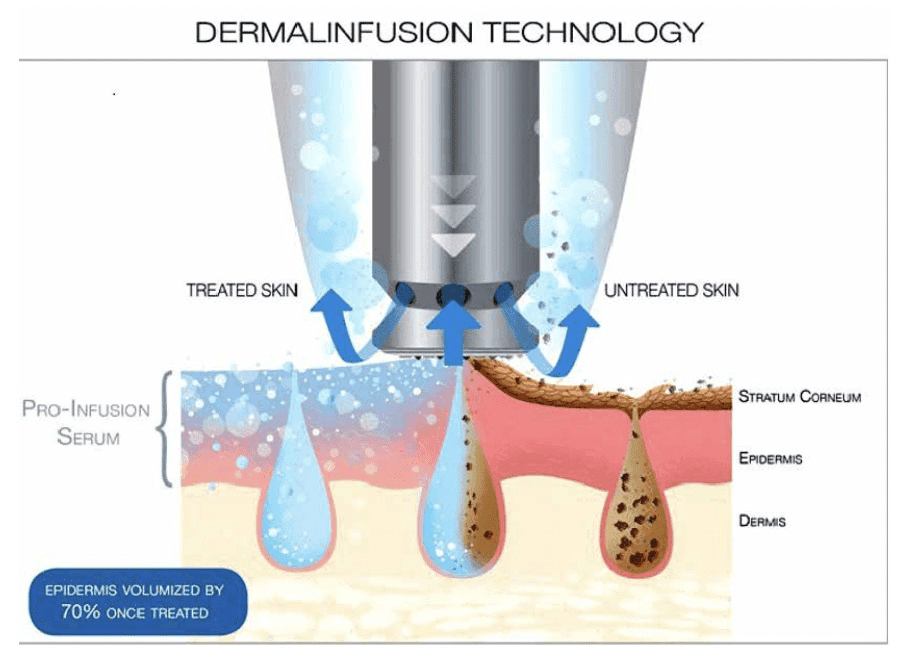 HYDRAFACIAL